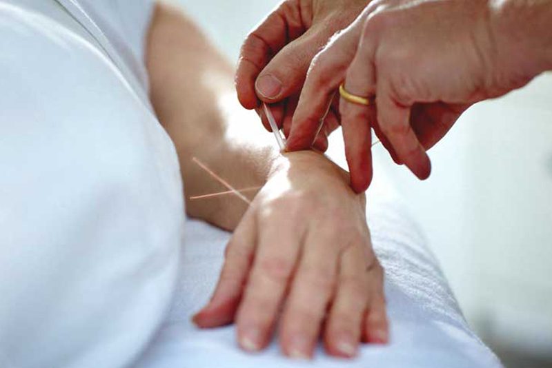 Acupuncture